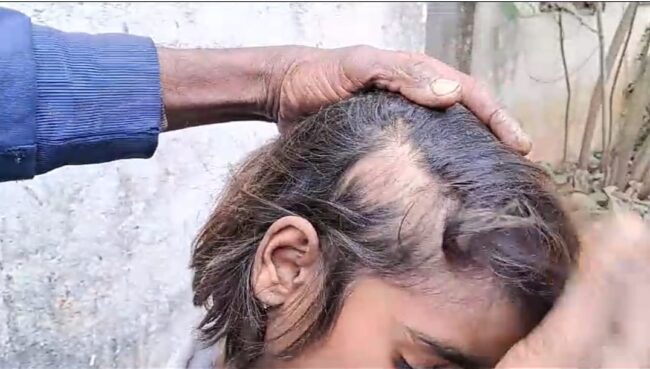 Betul News : शिक्षका द्वारा छात्रा के सिर के बाल उखाड़ने का मामला झूठा निकला